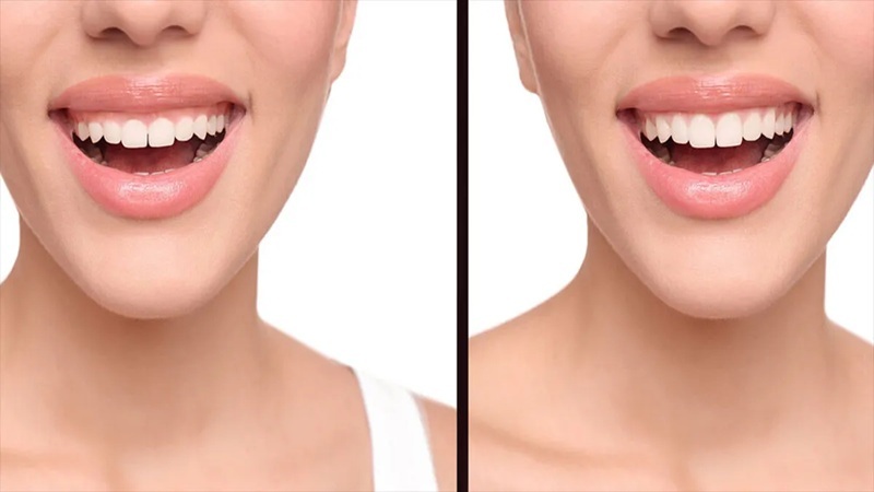 تفاوت لیفت لثه با لیزر و جراحی سنتی | بهترین دندانپزشک اصفهان-بهترین جراح لیفت لثه اصفهان-قیمت ایمپلنت دندان اصفهان| دکتر حسین برجیان