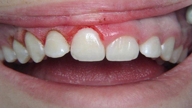 مزایا و معایب لیفت لثه | بهترین دندانپزشک اصفهان-بهترین جراح لیفت لثه اصفهان-قیمت ایمپلنت دندان اصفهان| دکتر حسین برجیان