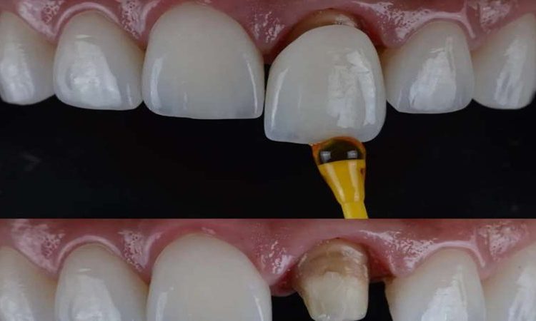 آیا روکش دندان باعث پوسیدگی می‌شود؟ | دکتر حسین برجیان (بهترین دندانپزشک اصفهان-بهترین جراح لثه اصفهان-بهترین دندانپزشک زیبایی اصفهان)