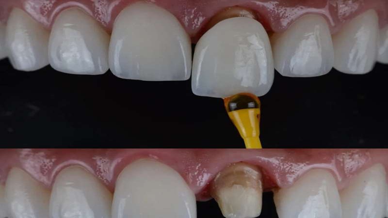 آیا روکش دندان باعث پوسیدگی می‌شود؟ | دکتر حسین برجیان (بهترین دندانپزشک اصفهان-بهترین جراح لثه اصفهان-بهترین دندانپزشک زیبایی اصفهان)