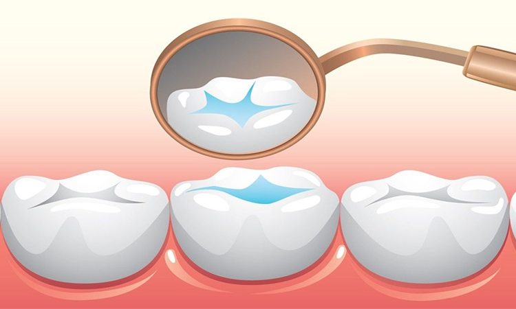 فیشورسیلانت چیست و برای چه کسانی مناسب است؟ | دکتر حسین برجیان (بهترین دندانپزشک اصفهان-بهترین جراح لثه اصفهان-بهترین دندانپزشک زیبایی اصفهان)
