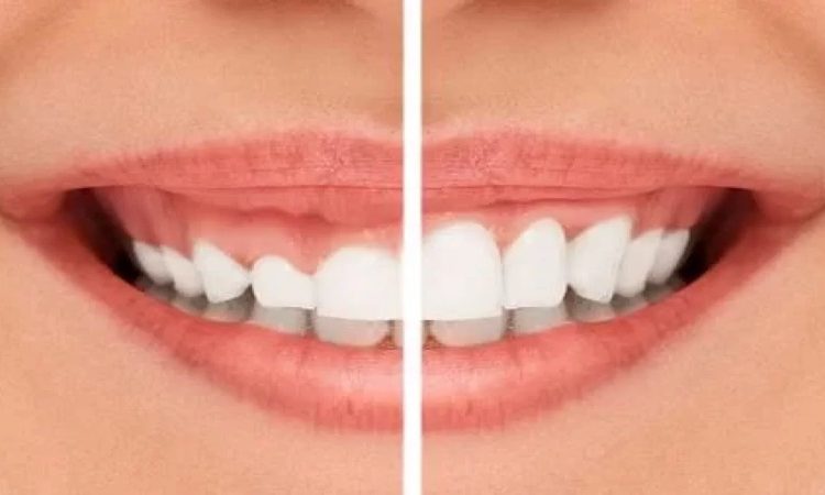 تفاوت لیفت لثه با لیزر و جراحی سنتی | بهترین دندانپزشک اصفهان-بهترین جراح لیفت لثه اصفهان-قیمت ایمپلنت دندان اصفهان| دکتر حسین برجیان