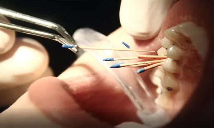 آیا عصب‌کشی دندان عوارض دارد؟ | دکتر حسین برجیان (بهترین دندانپزشک اصفهان-بهترین جراح لثه اصفهان-بهترین دندانپزشک زیبایی اصفهان)