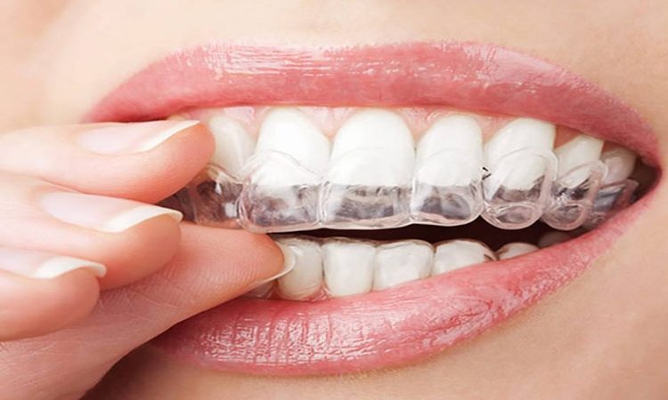 ارتودنسی نامرئی چیست و برای چه افرادی مناسب است؟ | دکتر حسین برجیان (بهترین دندانپزشک اصفهان-بهترین جراح لثه اصفهان-بهترین دندانپزشک زیبایی اصفهان)