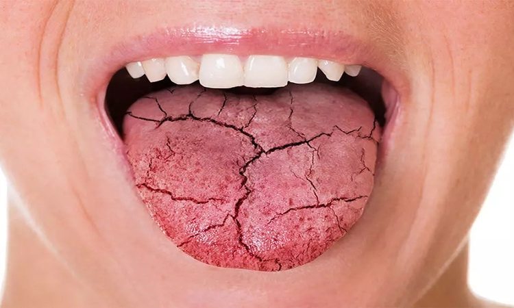 آیا خشکی دهان خطرناک است و چگونه درمان می‌شود؟ | دکتر حسین برجیان (بهترین دندانپزشک اصفهان-بهترین جراح لثه اصفهان-بهترین دندانپزشک زیبایی اصفهان)