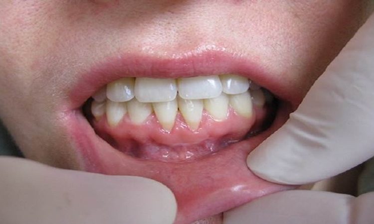 آیا بیماری لثه (پریودنتیت) قابل درمان کامل است؟ | دکتر حسین برجیان (بهترین دندانپزشک اصفهان-بهترین جراح لثه اصفهان-بهترین دندانپزشک زیبایی اصفهان)