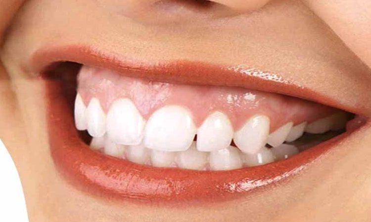 لیفت لثه چیست و چگونه لبخند را متحول می‌کند؟ | بهترین دندانپزشک اصفهان-بهترین جراح لیفت لثه اصفهان-قیمت ایمپلنت دندان اصفهان| دکتر حسین برجیان