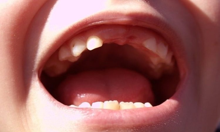 چه زمانی دندان‌های شیری کودک باید کشیده شوند؟ | دکتر حسین برجیان (بهترین دندانپزشک اصفهان-بهترین جراح لثه اصفهان-بهترین دندانپزشک زیبایی اصفهان)