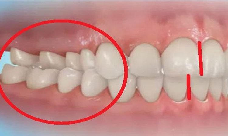 اپن‌بایت، کراس‌بایت و سایر مشکلات بایت چگونه تشخیص داده می‌شوند؟ | دکتر حسین برجیان (بهترین دندانپزشک اصفهان-بهترین جراح لثه اصفهان-بهترین دندانپزشک زیبایی اصفهان)