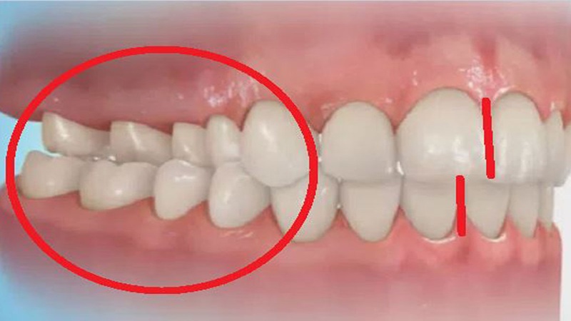 اپن‌بایت، کراس‌بایت و سایر مشکلات بایت چگونه تشخیص داده می‌شوند؟ | دکتر حسین برجیان (بهترین دندانپزشک اصفهان-بهترین جراح لثه اصفهان-بهترین دندانپزشک زیبایی اصفهان)