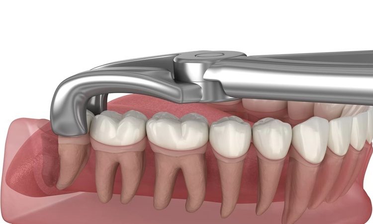 دندان عقل را چه زمانی باید کشید؟ | دکتر حسین برجیان (بهترین دندانپزشک اصفهان-بهترین جراح لثه اصفهان-بهترین دندانپزشک زیبایی اصفهان)