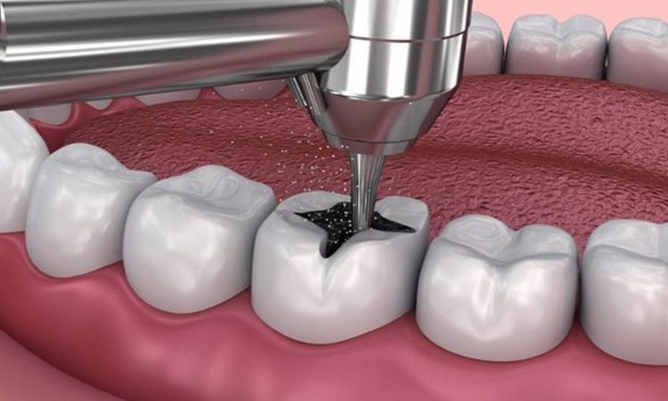 ترمیم مستقیم دندان حساس | بهترین دندانپزشک اصفهان-بهترین جراح لیفت لثه اصفهان-قیمت ایمپلنت دندان اصفهان| دکتر حسین برجیان