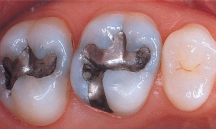 ترمیم مستقیم آمالگام | بهترین دندانپزشک اصفهان-بهترین جراح لیفت لثه اصفهان-قیمت ایمپلنت دندان اصفهان| دکتر حسین برجیان