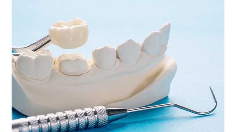 ترمیم مستقیم دندان قدیمی و آسیب‌دیده | بهترین دندانپزشک اصفهان-بهترین جراح لیفت لثه اصفهان-قیمت ایمپلنت دندان اصفهان| دکتر حسین برجیان