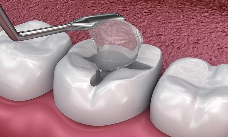 ترمیم مستقیم گلاس آینومر | بهترین دندانپزشک اصفهان-بهترین جراح لیفت لثه اصفهان-قیمت ایمپلنت دندان اصفهان| دکتر حسین برجیان