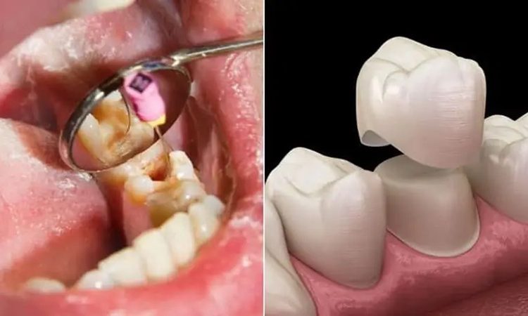 آیا امکان نجات دندان بدون برداشتن روکش وجود دارد؟ | بهترین دندانپزشک اصفهان-بهترین جراح لیفت لثه اصفهان-قیمت ایمپلنت دندان اصفهان| دکتر حسین برجیان