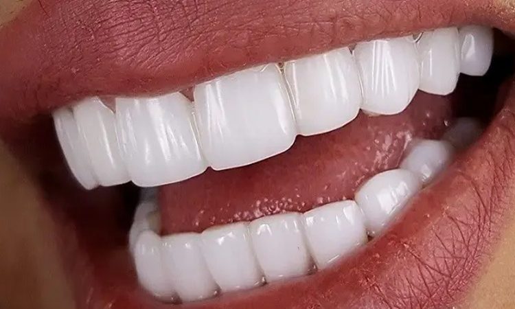 ترمیم مستقیم کامپوزیت | بهترین دندانپزشک اصفهان-بهترین جراح لیفت لثه اصفهان-قیمت ایمپلنت دندان اصفهان| دکتر حسین برجیان