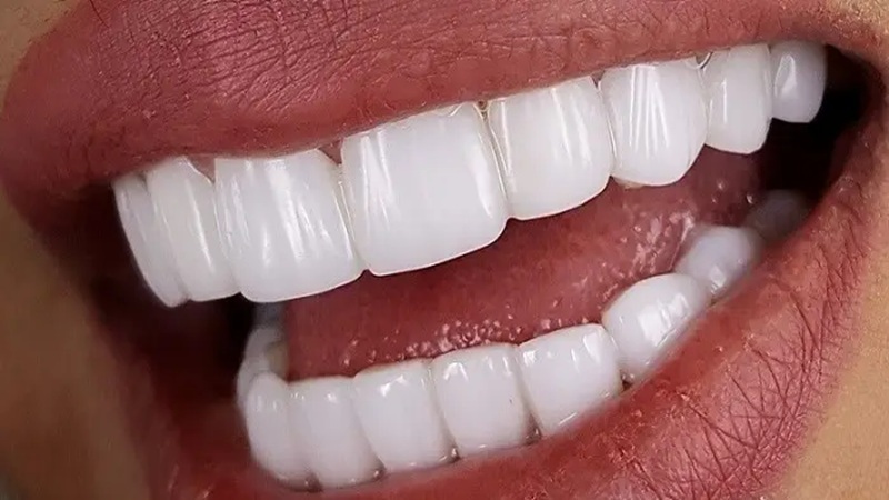 ترمیم مستقیم کامپوزیت | بهترین دندانپزشک اصفهان-بهترین جراح لیفت لثه اصفهان-قیمت ایمپلنت دندان اصفهان| دکتر حسین برجیان