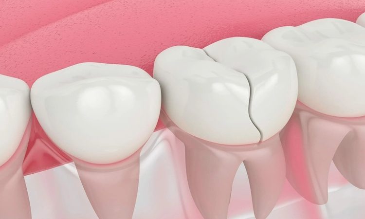 ترمیم مستقیم دندان ترک خورده | بهترین دندانپزشک اصفهان-بهترین جراح لیفت لثه اصفهان-قیمت ایمپلنت دندان اصفهان| دکتر حسین برجیان