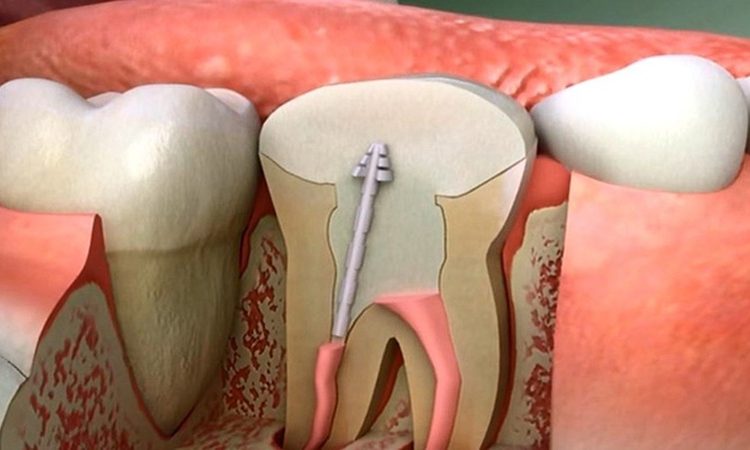 درمان ریشه دندان درد دارد؟ | بهترین دندانپزشک اصفهان-بهترین جراح لیفت لثه اصفهان-قیمت ایمپلنت دندان اصفهان| دکتر حسین برجیان