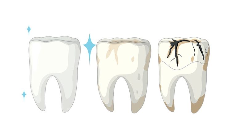 ترمیم مستقیم دندان ترک خورده ناشی از پوسیدگی | بهترین دندانپزشک اصفهان-بهترین جراح لیفت لثه اصفهان-قیمت ایمپلنت دندان اصفهان| دکتر حسین برجیان