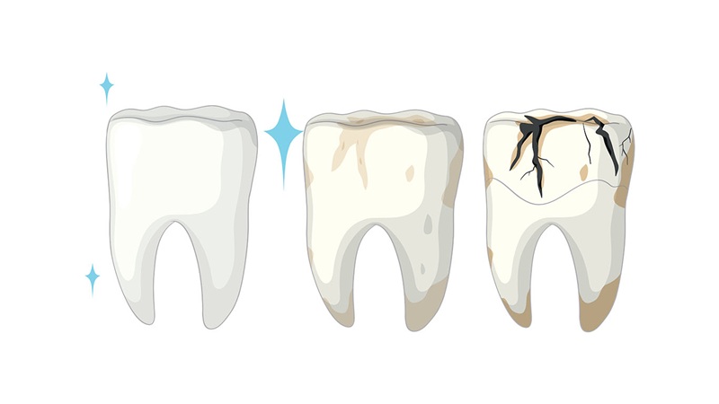 ترمیم مستقیم دندان ترک خورده ناشی از پوسیدگی | بهترین دندانپزشک اصفهان-بهترین جراح لیفت لثه اصفهان-قیمت ایمپلنت دندان اصفهان| دکتر حسین برجیان
