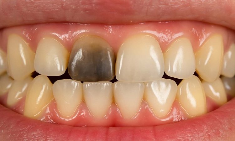 آیا دندانی که سیاه شده هنوز قابل نجات است؟ | بهترین دندانپزشک اصفهان-بهترین جراح لیفت لثه اصفهان-قیمت ایمپلنت دندان اصفهان| دکتر حسین برجیان