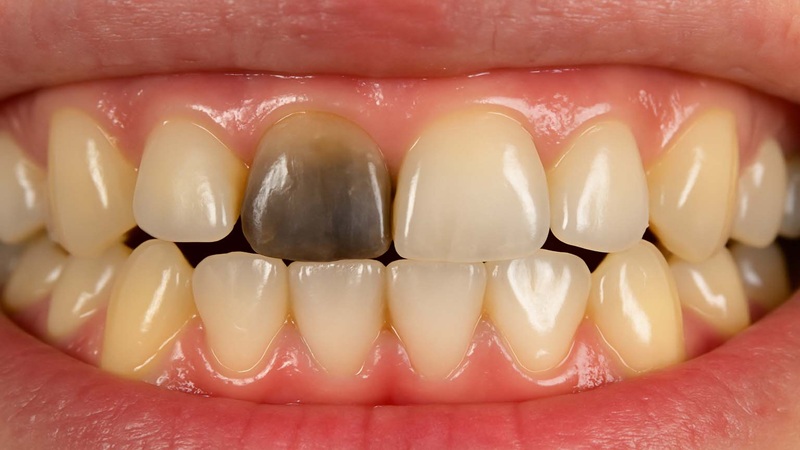 آیا دندانی که سیاه شده هنوز قابل نجات است؟ | بهترین دندانپزشک اصفهان-بهترین جراح لیفت لثه اصفهان-قیمت ایمپلنت دندان اصفهان| دکتر حسین برجیان