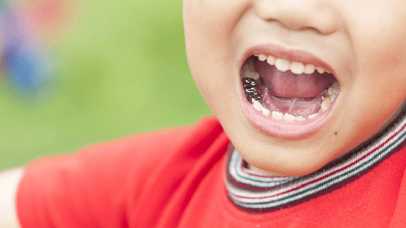 آیا دندان شیری هم نیاز به عصب‌کشی دارد؟ | بهترین دندانپزشک اصفهان-بهترین جراح لیفت لثه اصفهان-قیمت ایمپلنت دندان اصفهان| دکتر حسین برجیان