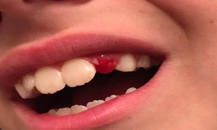 آیا دندان شکسته قابل نجات است؟ | بهترین دندانپزشک اصفهان-بهترین جراح لیفت لثه اصفهان-قیمت ایمپلنت دندان اصفهان| دکتر حسین برجیان