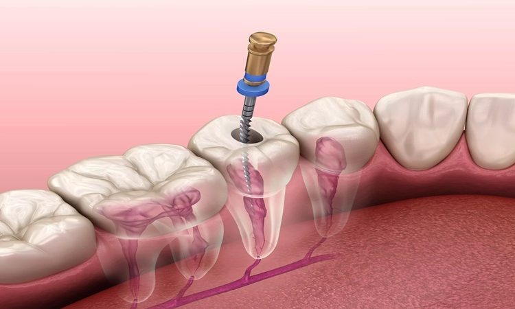 درمان ریشه دندان چیست و چرا تنها راه نجات دندان است؟ | بهترین دندانپزشک اصفهان-بهترین جراح لیفت لثه اصفهان-قیمت ایمپلنت دندان اصفهان| دکتر حسین برجیان