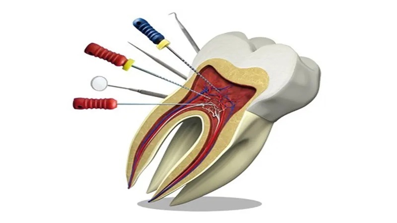 ترمیم مستقیم دندان پس از درمان ریشه | بهترین دندانپزشک اصفهان-بهترین جراح لیفت لثه اصفهان-قیمت ایمپلنت دندان اصفهان| دکتر حسین برجیان