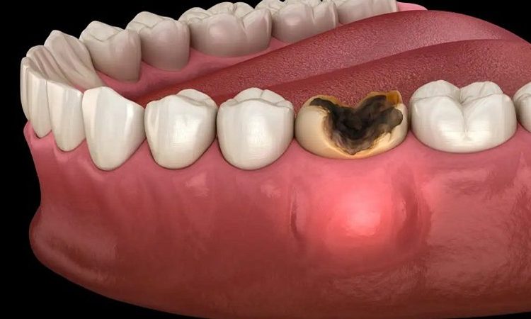 چرا برخی دندان‌ها پس از درمان دوباره عفونی می‌شوند؟ | بهترین دندانپزشک اصفهان-بهترین جراح لیفت لثه اصفهان-قیمت ایمپلنت دندان اصفهان| دکتر حسین برجیان